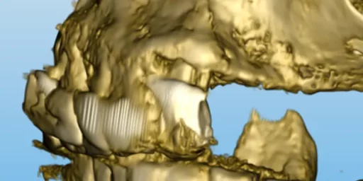 Cone Beam pour évaluer la masse osseuse