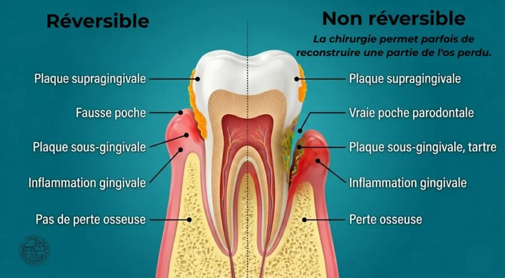 Coupe d'une dent avec d'un coté les aspects réversibles et non réversibles.